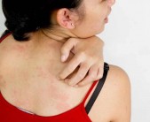 Лечение распространённых проблем кожи и аллергических реакций